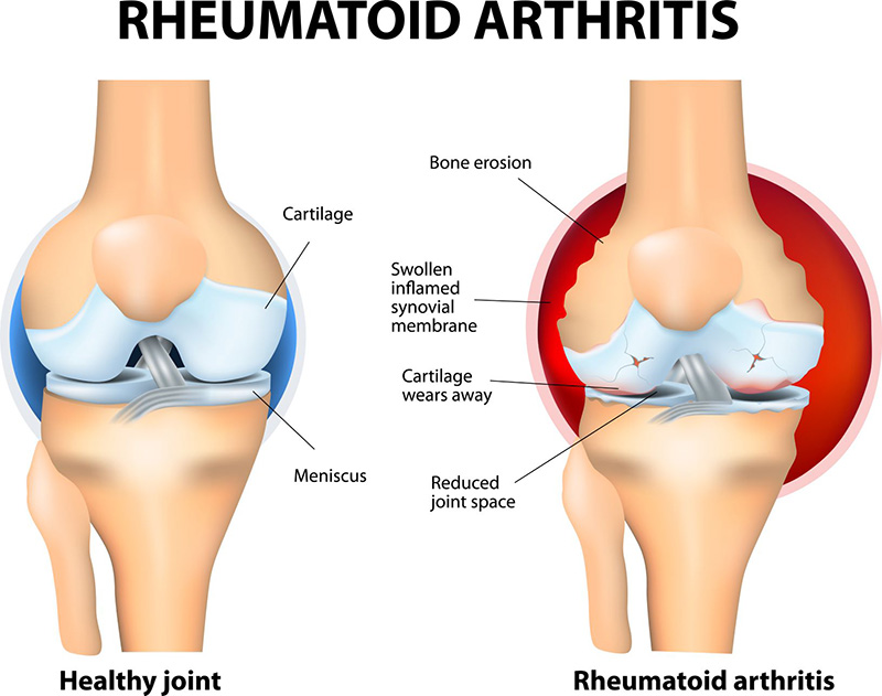 RA is an autoimmune disease that affects the synovial joints of the body. It is three times more common in women than in men. (Photo: Shutterstock) 